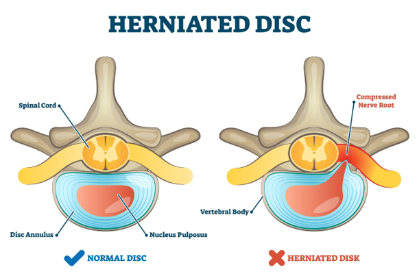 herniated disc